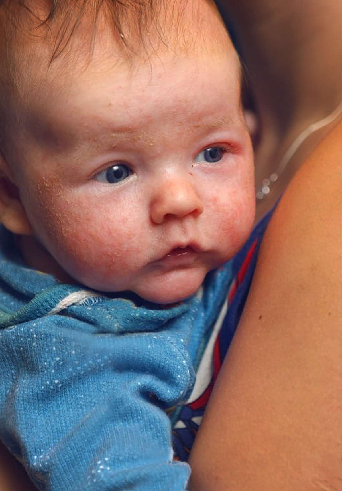 Baby eczema GAPS Diet.